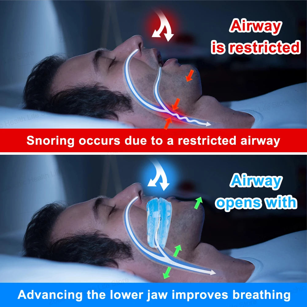 Anti-Snoring Mouthpiece Adjustable Anti Snoring Mouth Guard Sleeping Devices Bruxism Snoring Stopper Improve Sleep Mouthpiece